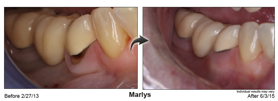 fix receding gums Oklahoma City